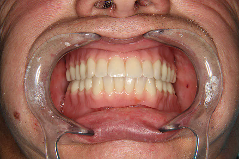 зубные импланты фото