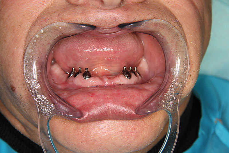 импалнтация зубов до-после 