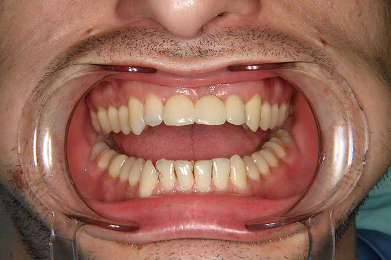 имплант зуба цена