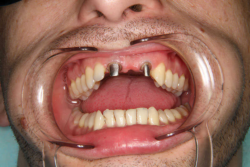 импланты зубов в твери цена под ключ