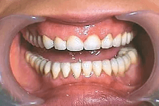 зубные импланты фото