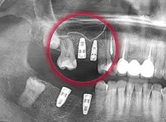 имплант зуба цена