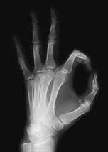 Рентгеновский снимок кистей рук