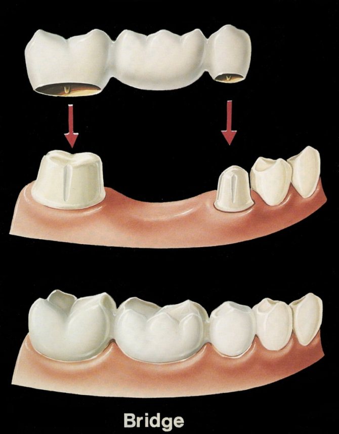 Как выглядят мосты в стоматологии