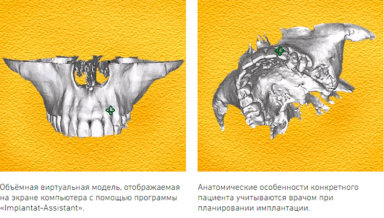 Программы для 3д моделирования зубов