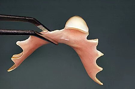 Съемный зуб бабочка. Микропротез бабочка/ иммедиат-протез. Иммедиат протез бабочка 1 зуб. Микропротез бабочка на 2 зуба.
